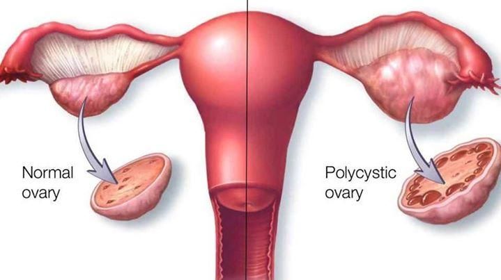 Normal vs PCOS ovary