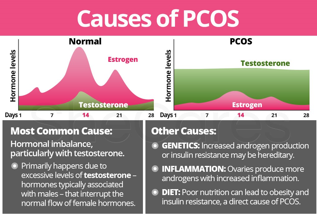 Causes of PCOS and estrogen vs testosterone