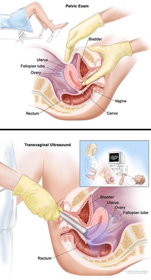 Pelvic exam & transvaginal ultrasound